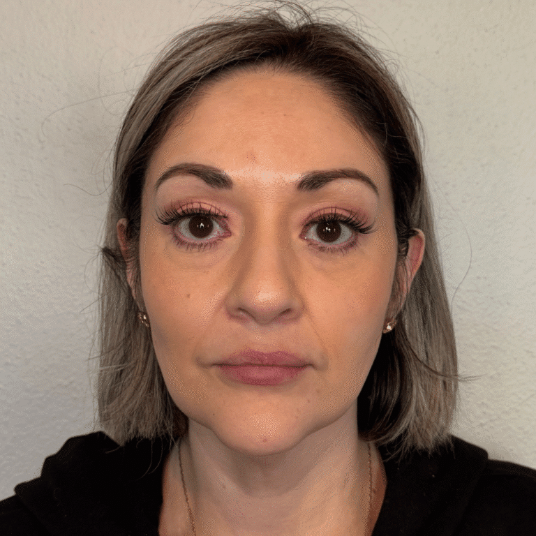 Before Image: Sculptra - front