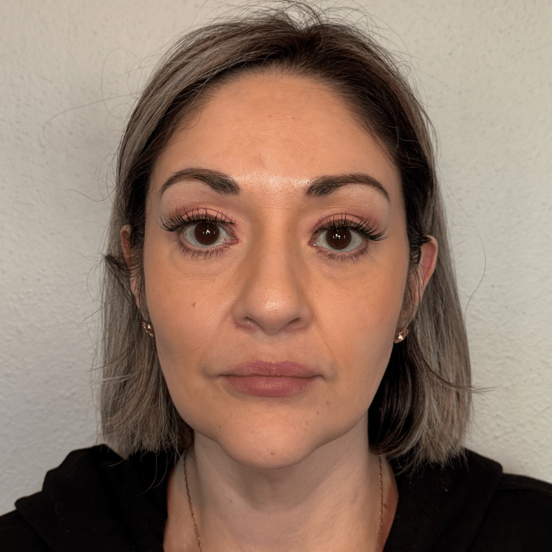 Before Image: Botox & Filler - front