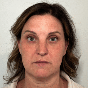 Before Image: Botox & Filler