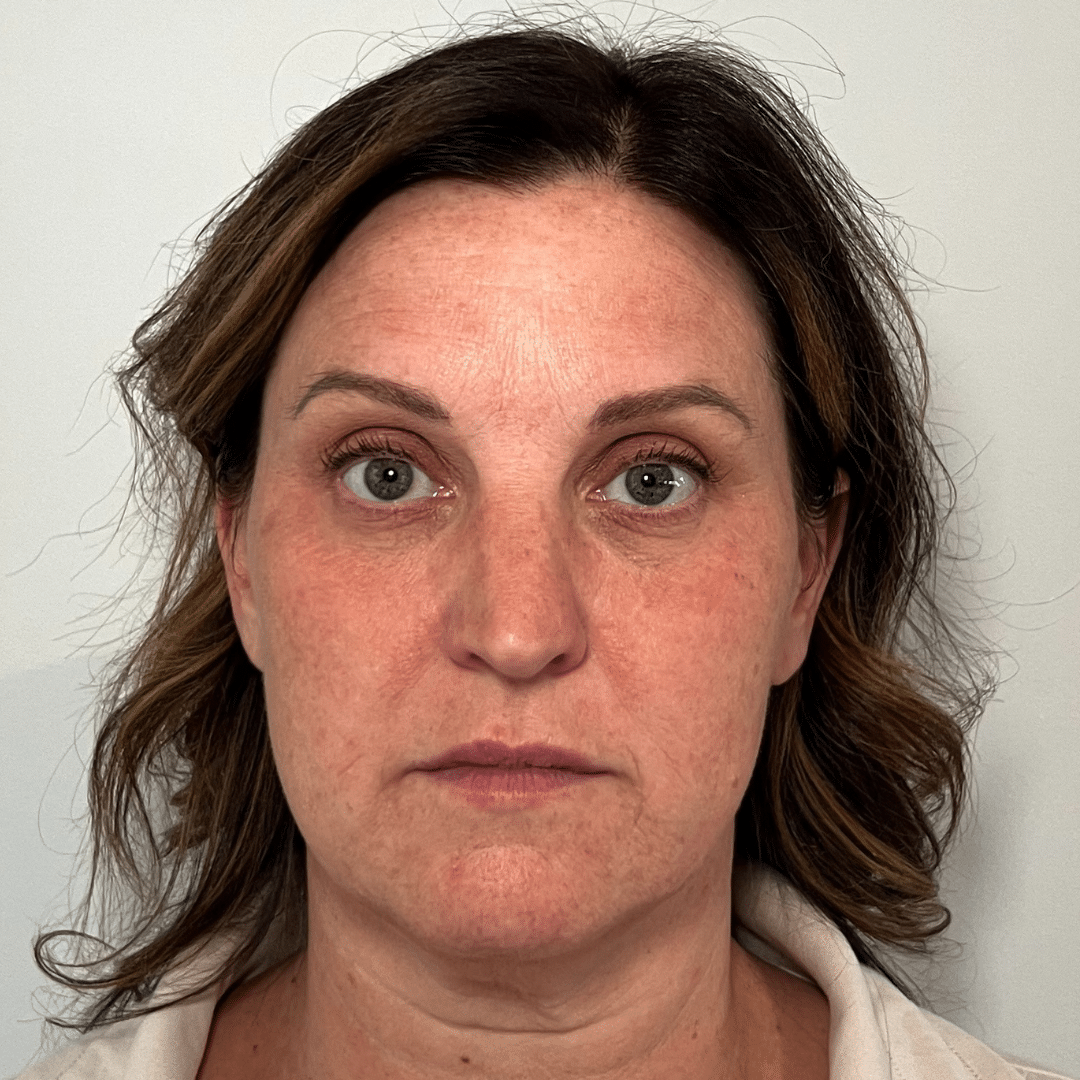 Before Image: Botox & Filler - front