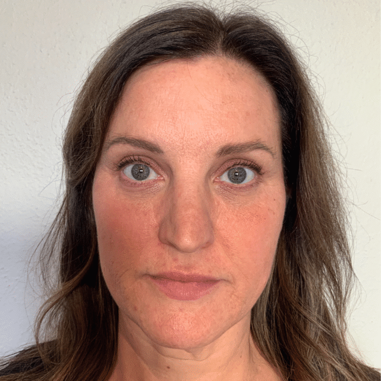 After Image: Botox & Filler - front
