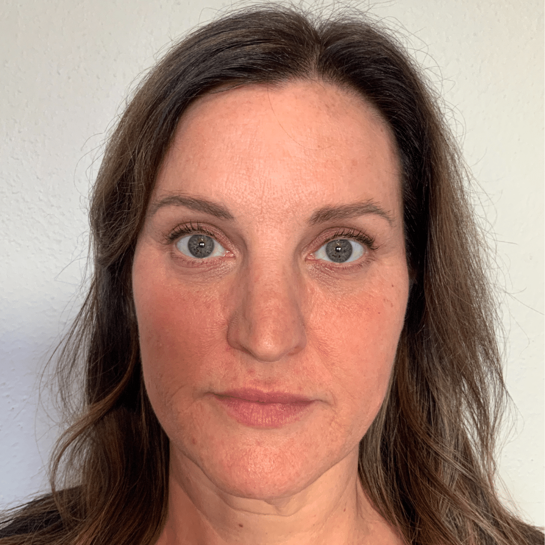 After Image: Botox & Filler - front