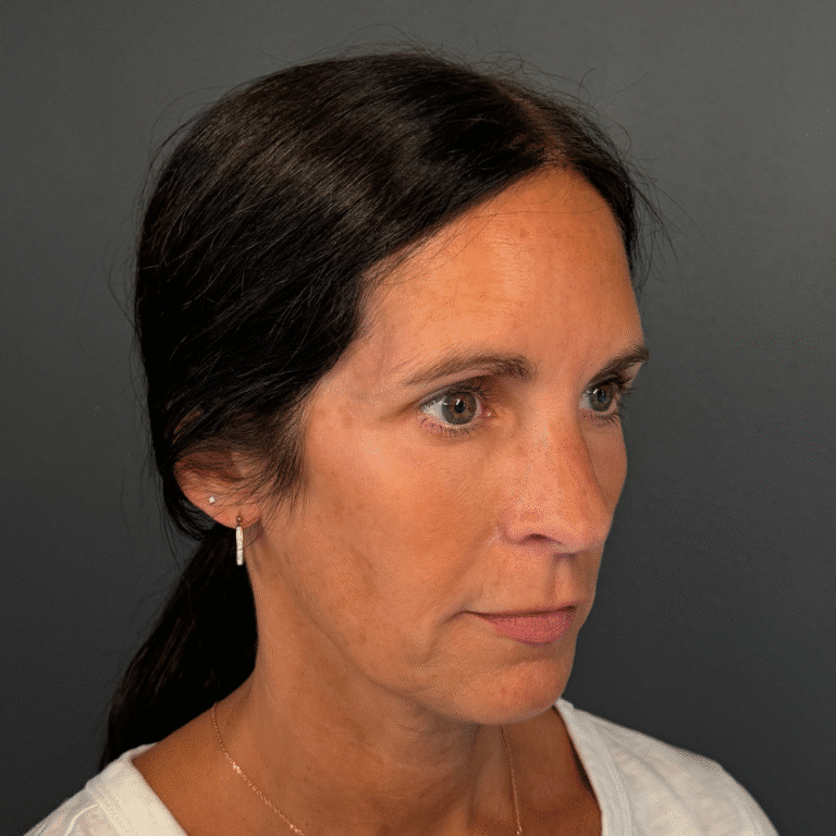 Before Image: Filler - right-front-oblique