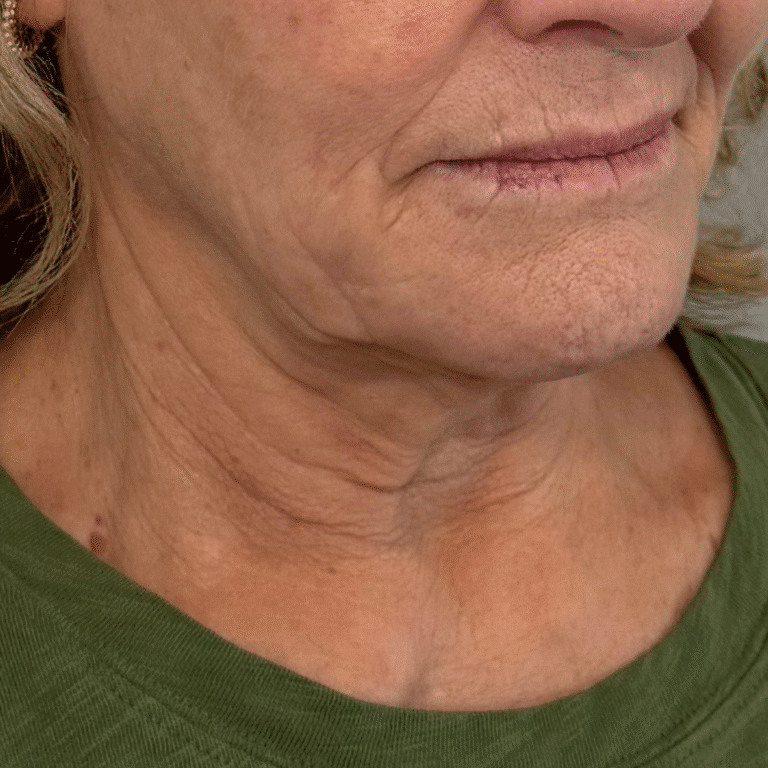 Before Image: Botox - front