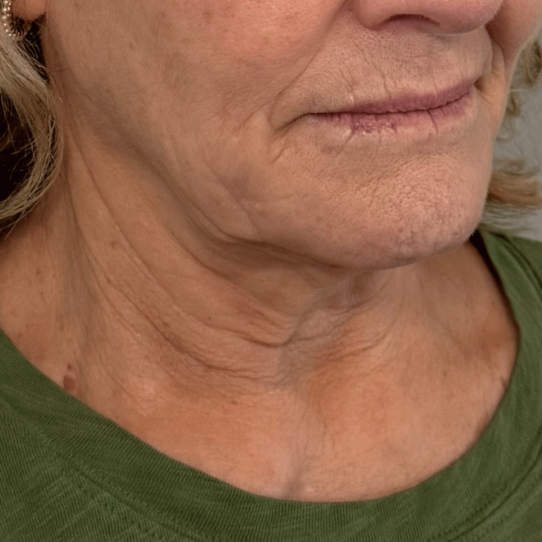 Before Image: Botox - front