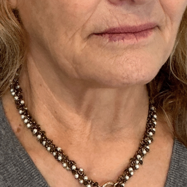 After Image: Botox - front