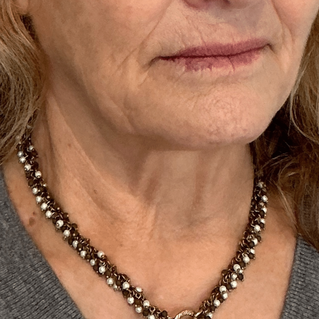 After Image: Botox - front