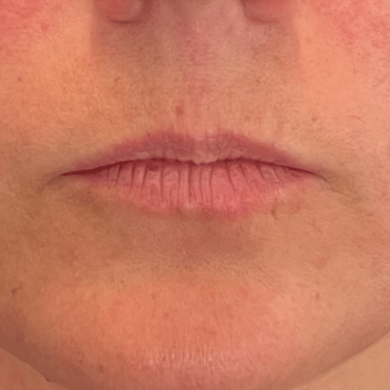 Before Image: Lip Filler - front