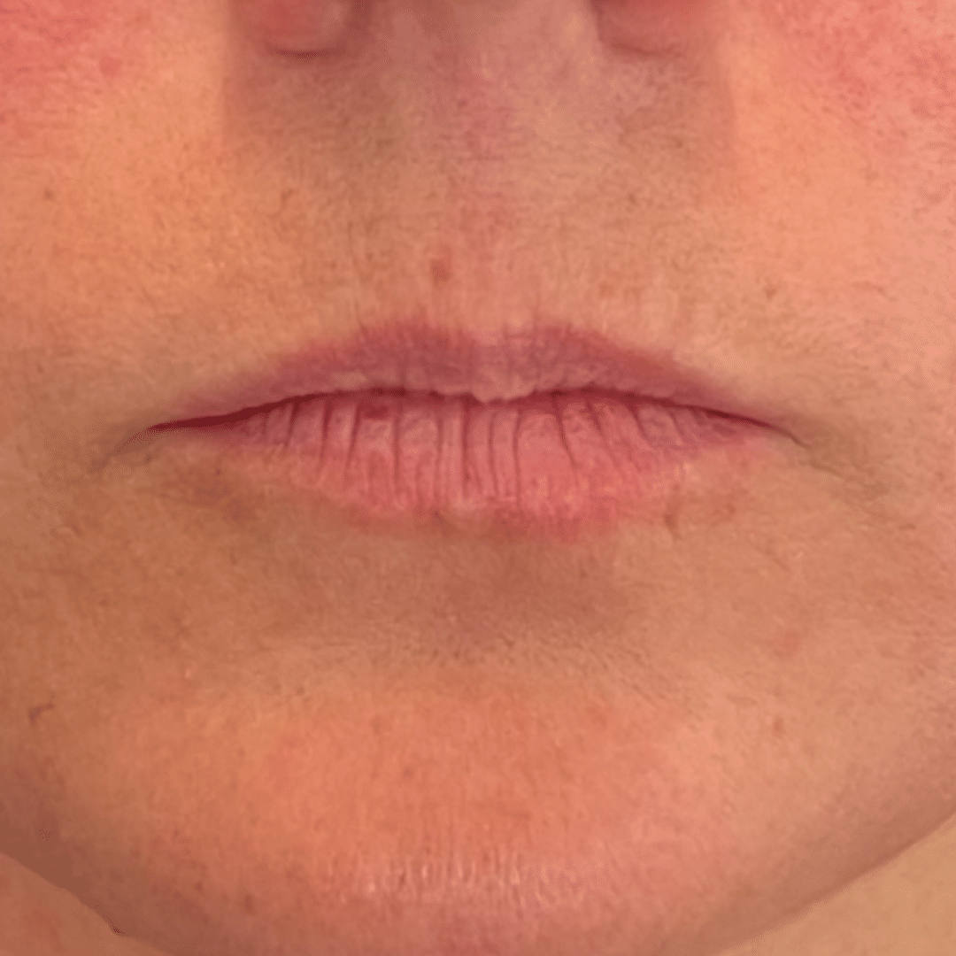 Before Image: Lip Filler - front