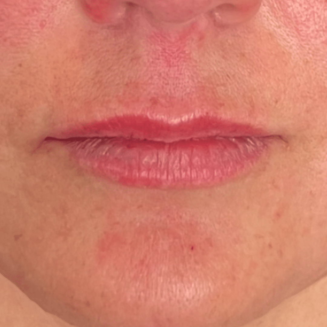 After Image: Lip Filler - front