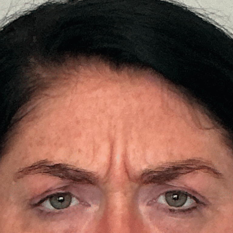 Before Image: Botox - front