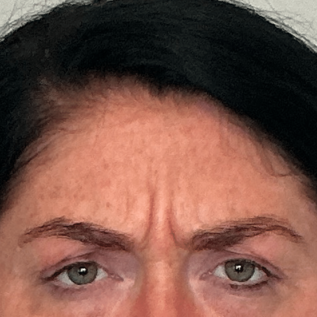 Before Image: Botox - front