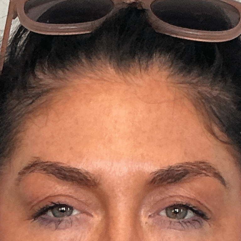 After Image: Botox - front