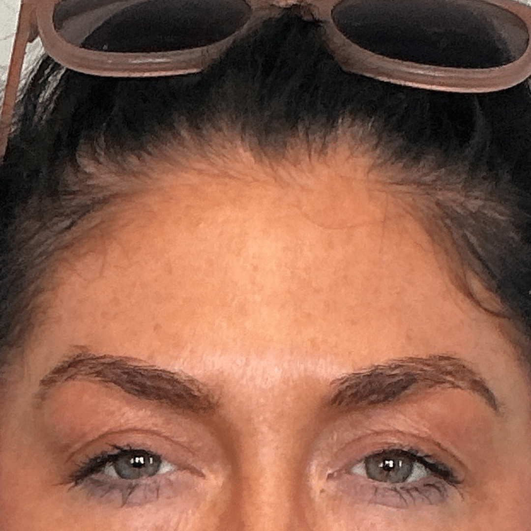 After Image: Botox - front