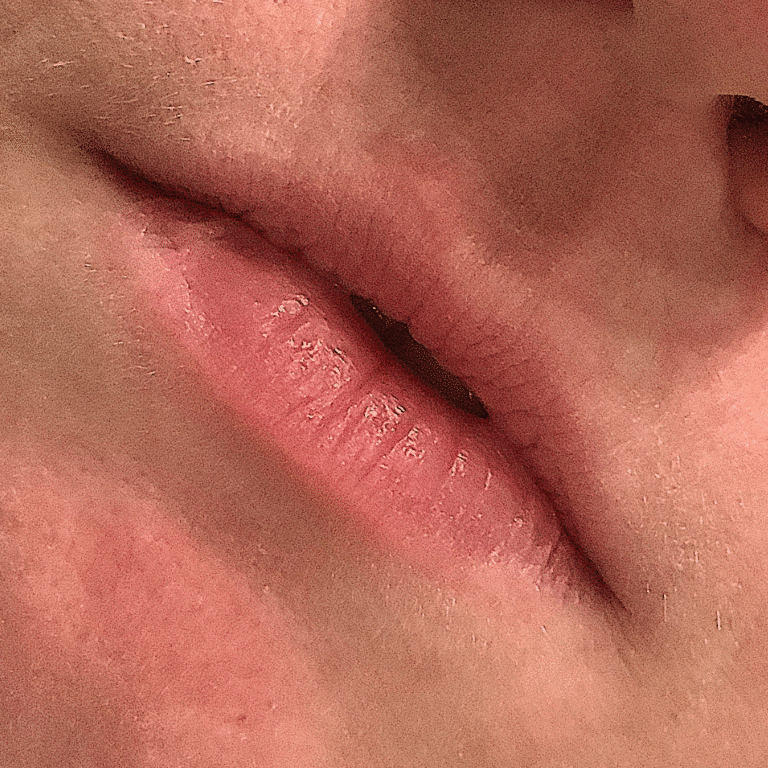 Before Image: Lip Filler - front