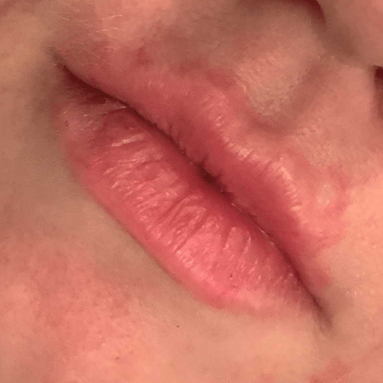 After Image: Lip Filler - front