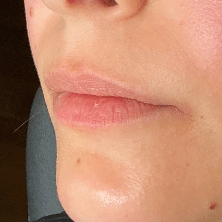 Before Image: Lip Filler - left-front-oblique