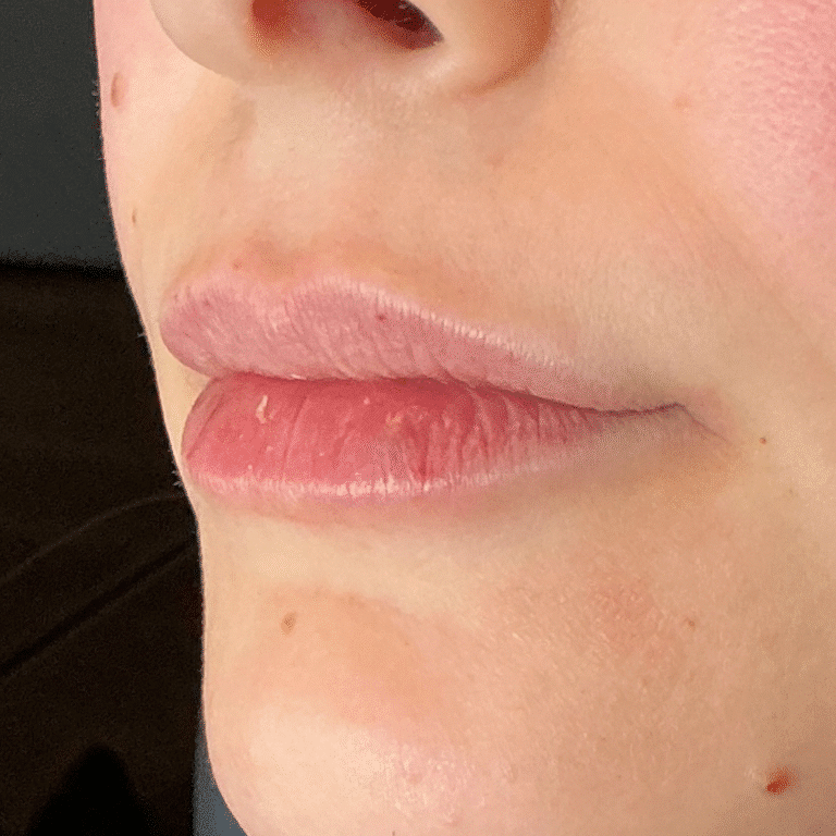 After Image: Lip Filler - left-front-oblique