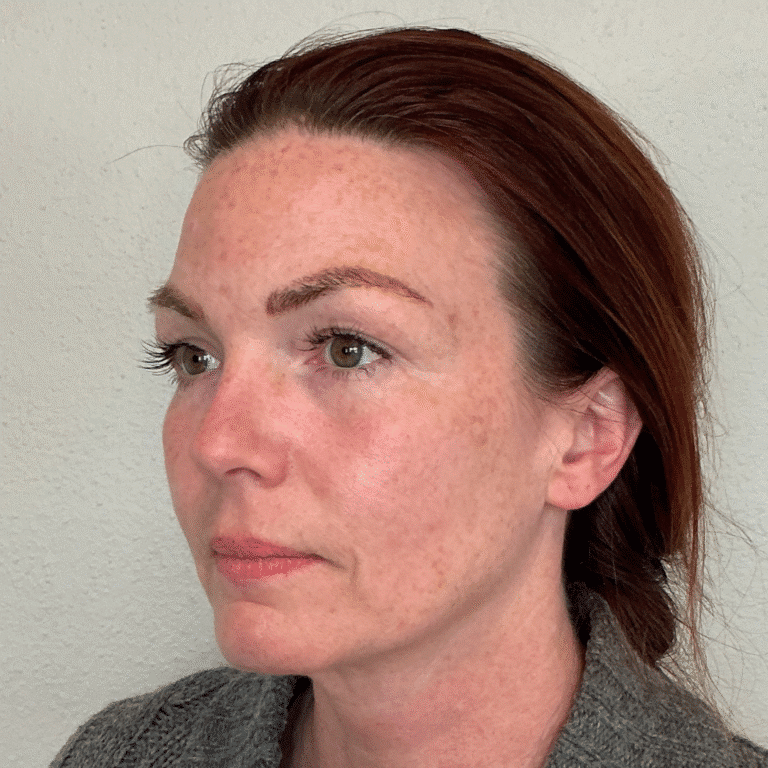 Before Image: Filler - 