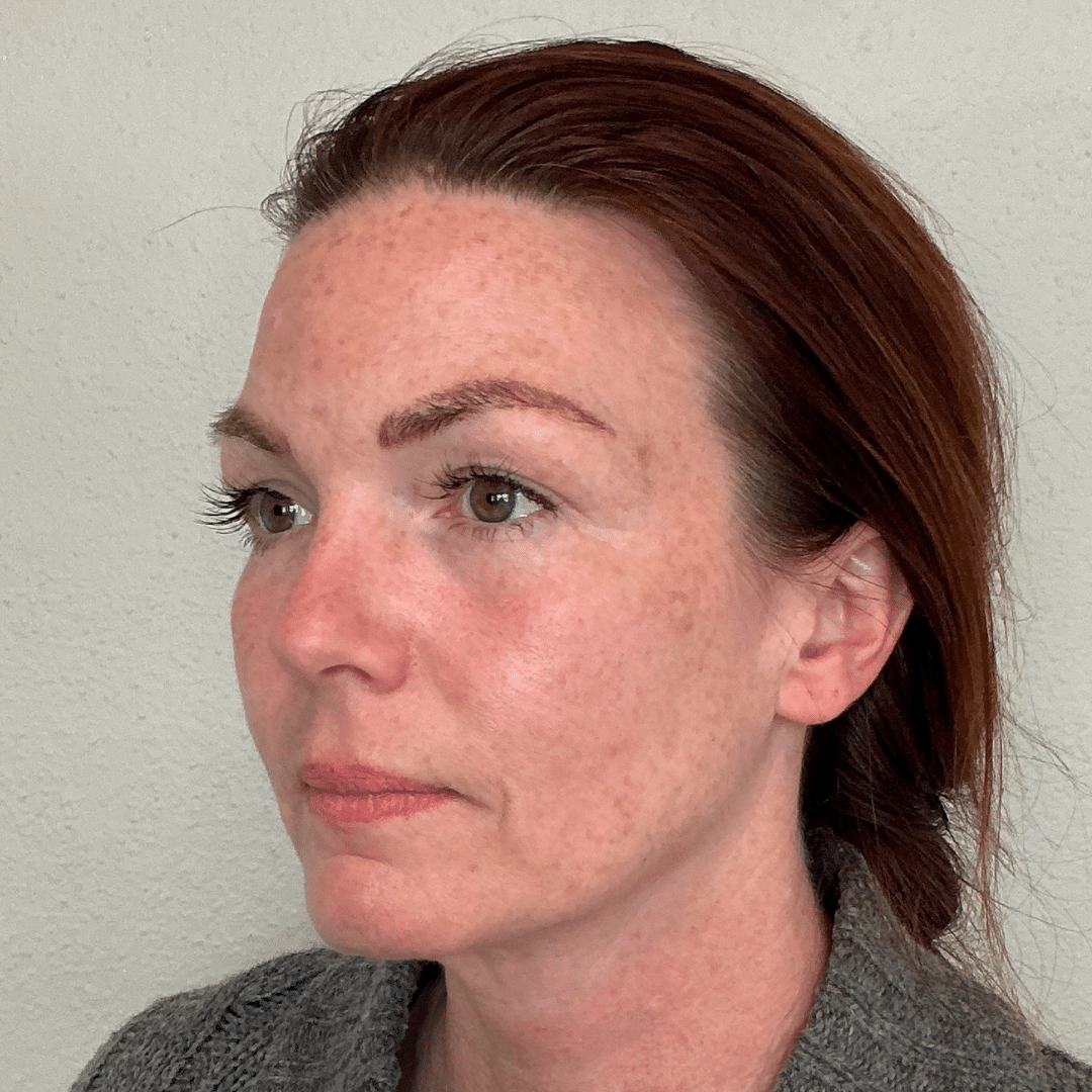 Before Image: Filler - 