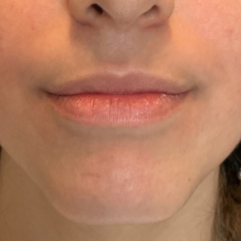 Before Image: Lip Filler - front