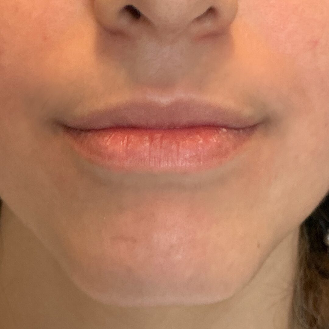 Before Image: Lip Filler - front