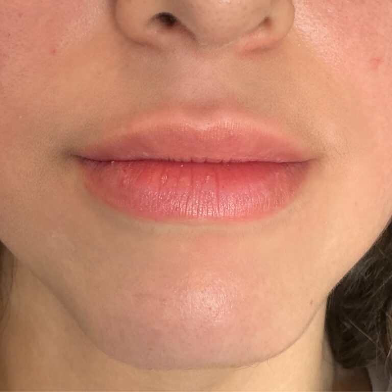 After Image: Lip Filler - front